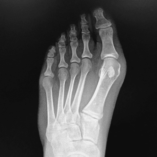 Bone Spurs