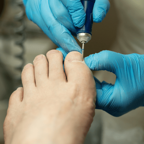 Ingrown Toenails