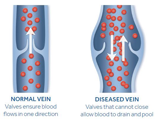 A normal vs a diseased vein. Normal vein valves ensure blood flows in one direction. Diseased vein valves that cannot close allow blood to drain and pool.
