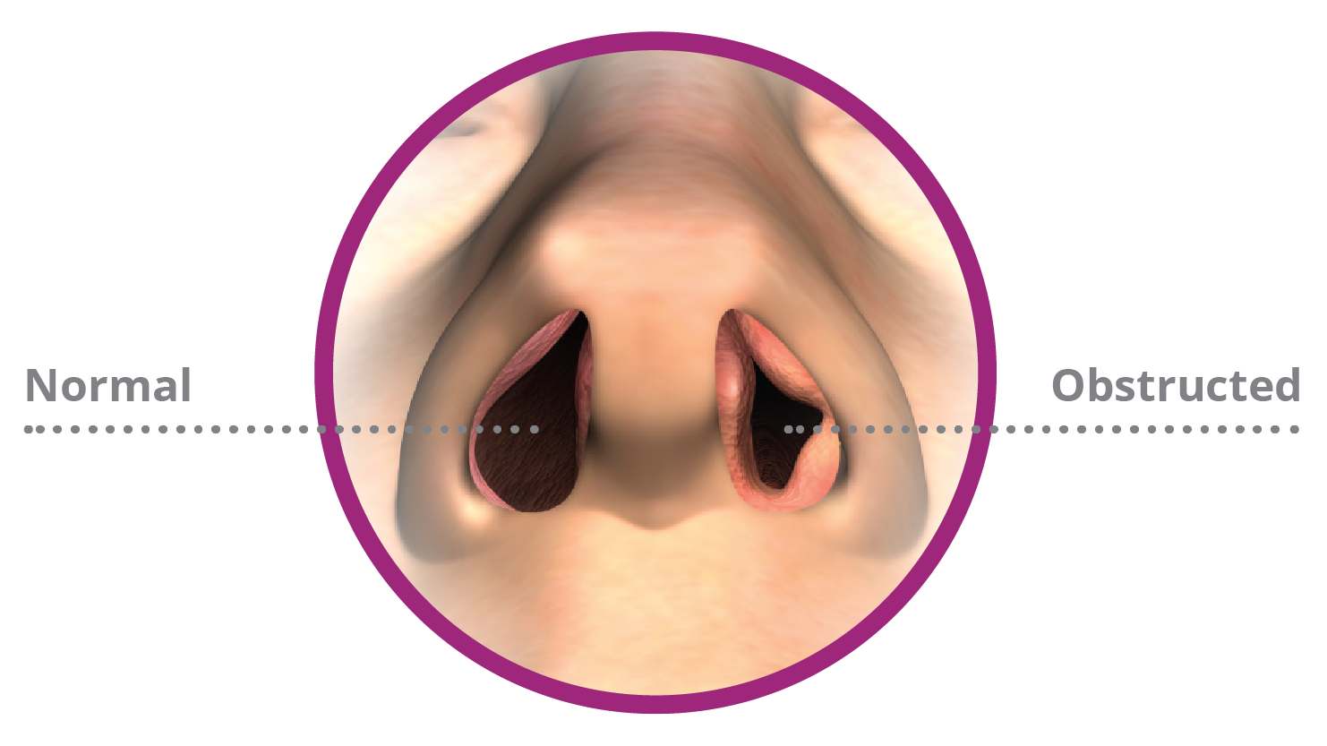 normal nasal passage way versus an obstructed passage way.