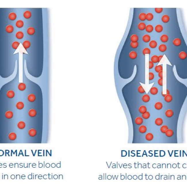 Normal vein valves ensure blood flows in one direction. Diseased vein valves that cannot close allow blood to drain and pool